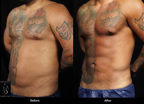 male liposuction miami|Liposuction for Men Miami 